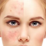Girl  with problem and clear skin.